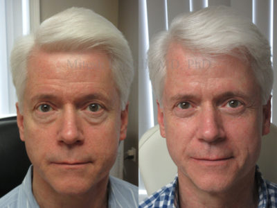 Man in his early 60s after lower eyelid surgery showing a refreshed and younger look