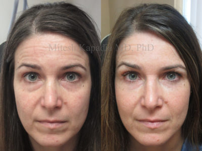 Woman in her early 40s before and after lower eyelid filler injections, revealing a smoother eyelid to cheek junction, and a less tired tired look