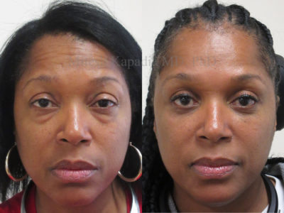 Woman in her late 40s before and after lower eyelid surgery with removal of fat pockets from the inner corner of her upper eyelids. She appears more youthful and less tired while maintaining a natural look