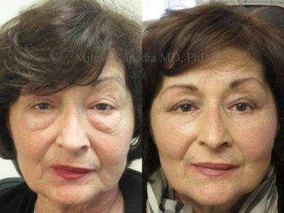 Woman in her mid-60s before and after lower eyelid surgery with skin pinch and canthopexy, appearing less tired and rejuvenated after her procedure