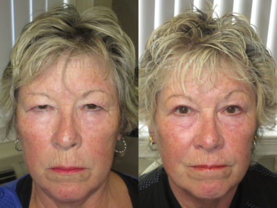 Woman in her 70s before and after upper eyelid surgery, revealing much less hooding over her eyes, making her appear rejuvenated and more youthful