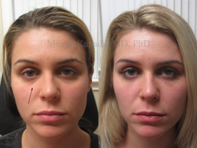 Woman in her late 20s before and after lower eyelid filler injections, revealing reduced hollowing and dark circles, making her appear less tired and rejuvenated