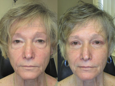 Woman in her 70s before and after upper and lower eyelid surgery, displaying a less tired, more youthful appearance