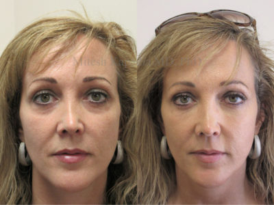 Woman in her mid-50s before and after lower eyelid filler injections, displaying diminished dark circles under the eyes, leaving her with a refreshed appearance