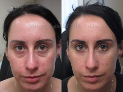 Woman in her early 30s before and after midface and lower eyelid filler injections, showing a great reduction in under eye dark circles and puffiness, leaving her looking refreshed and vibrant