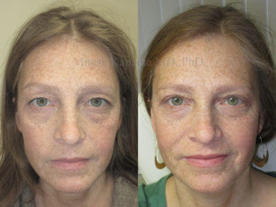 Woman in her early 40s before and after upper eyelid surgery, leaving her with a natural, refreshed and more youthful look