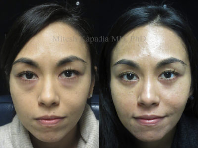 Woman in her mid-30s before and after lower eyelid surgery, with lower eyelid filler injections done after her procedure. She appears less tired and rejuvenated, while still looking natural
