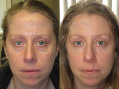 Woman in her 30s before and after lower eyelid and midface fillers, appearing refreshed and well rested three weeks after her injections