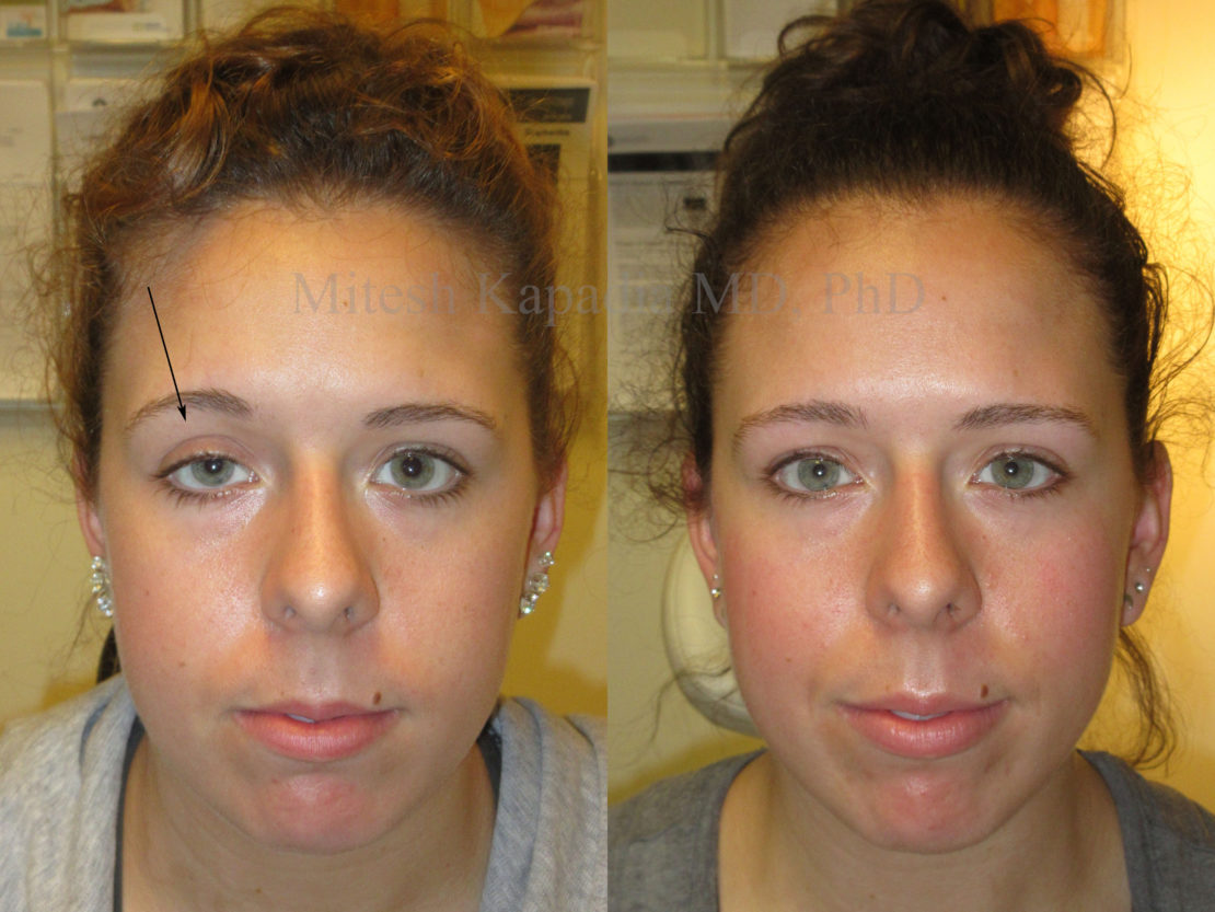 Woman in her 20s before and after ptosis repair surgery, showing improved symmetry and eyelid position