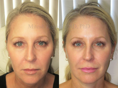Woman in her late 40s appears more awake and less tired after upper eyelid surgery