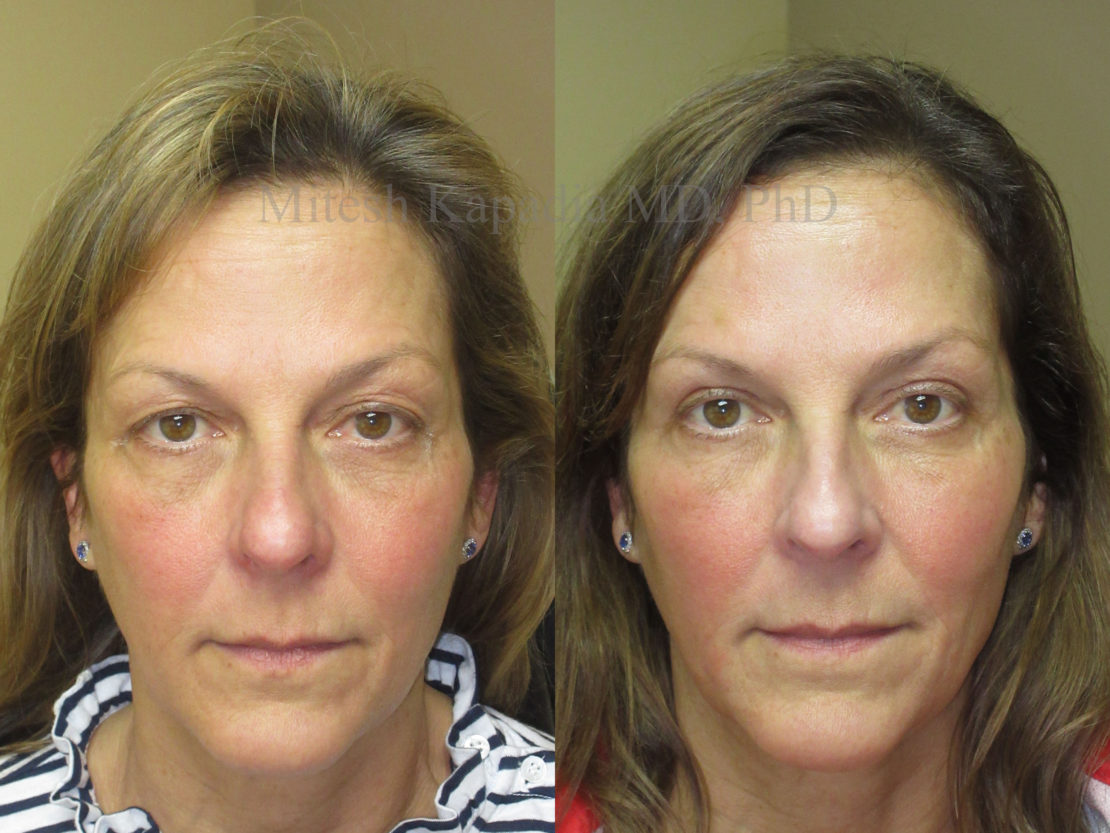 Woman in her 50s looks more awake after upper eyelid surgery.