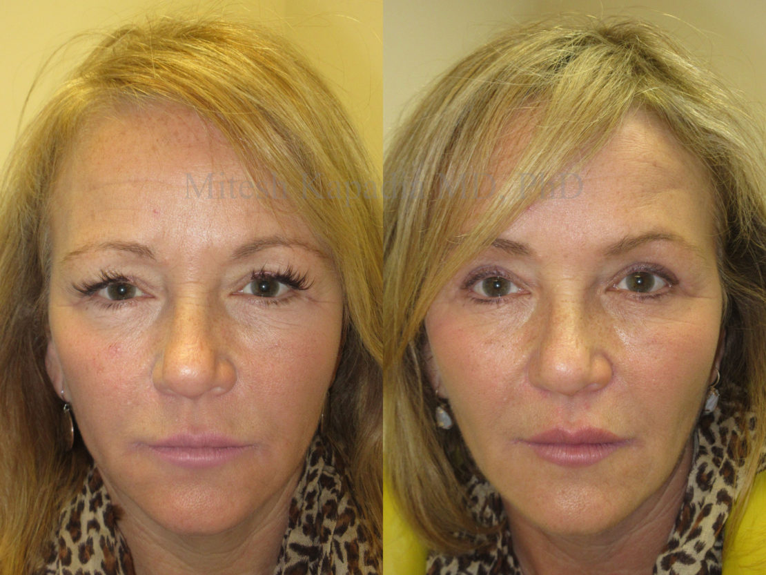 Woman in her late 50s shown to display a younger, refreshed appearance after upper eyelid surgery