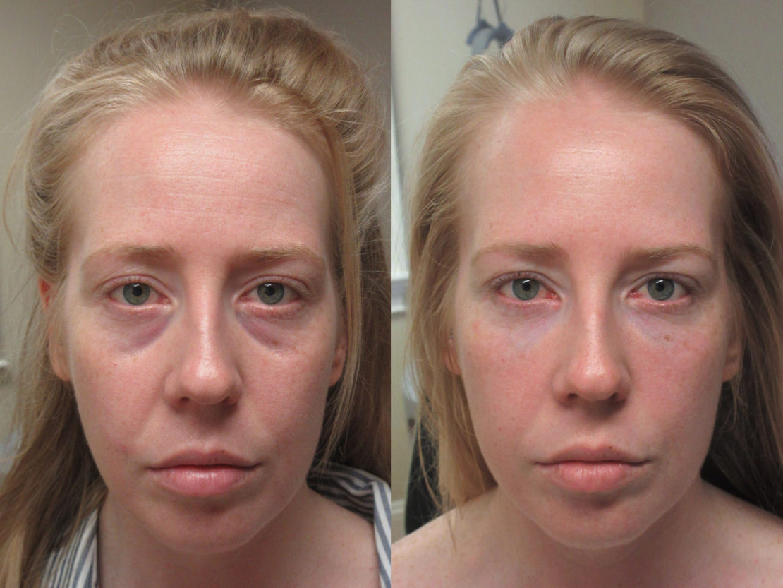 Woman in her mid-30s shown before and after lower eyelid and midface fillers. The after photo shows a great reduction of darkness under her eyes, giving her a less tired and rejuvenated appearance