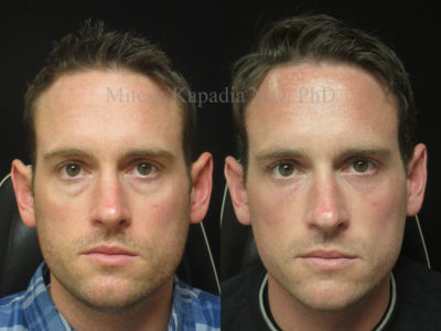Man in his early 30s before and after lower eyelid and midface fillers,