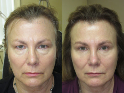 Woman in her mid-50s before and after upper and lower eyelid surgery, revealing a refreshed and less tired appearance