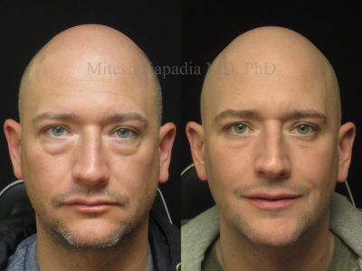 Man in his late 30s before and after lower eyelid surgery, appearing less tired and refreshed four months after his procedure