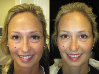 Woman in her 30s before and after lower eyelid surgery and undereye filler injections done six weeks after her procedure. She appears refreshed without looking overdone or surgical