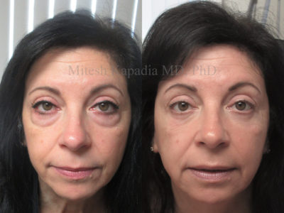 Woman in her 50s before and after lower eyelid surgery, with lower eyelid fillers done after her procedure, displaying a more youthful, less tired look