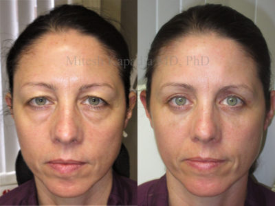 Woman in her 40s before and after upper and lower eyelid surgery, with undereye filler injections done six weeks after her procedure, appearing less tired and rejuvenated