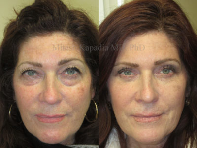 Woman in her mid-50s before and after upper and lower eyelid surgery, leaving her with a more symmetrical and youthful look