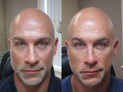 Man in his mid-40s before and after lower eyelid filler injections, displaying a subtle refreshed appearance
