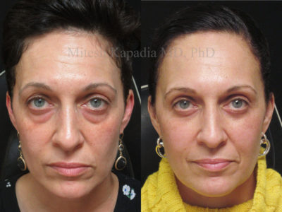 Woman in her mid-40s before and after lower eyelid surgery, showing a less tired, rejuvenated appearance