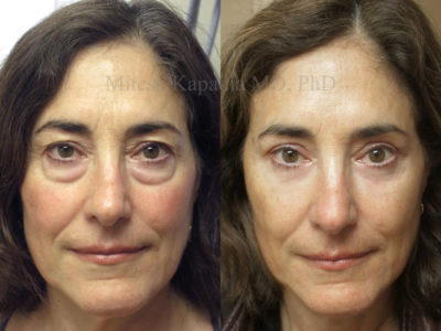 Woman in her early 60s after upper and lower eyelid surgery looks younger, less tired and refreshed