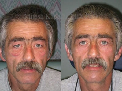 Man in his 50s before and after upper eyelid surgery, direct festoonectomy and lateral canthoplasty, displaying nearly diminished undereye bags, and a more youthful, less tired appearance