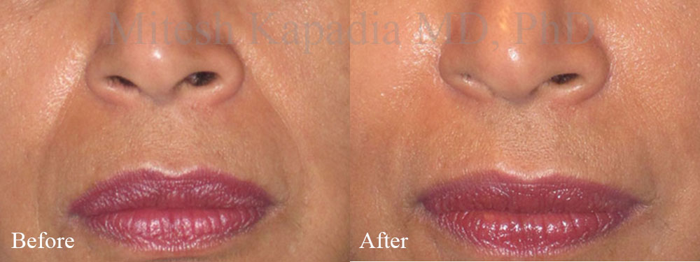 Before and after nasolabial fold fillers