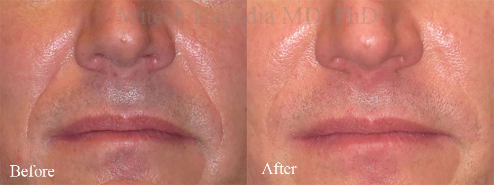 Before and after nasolabial fold fillers