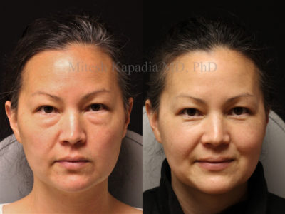 Woman in her early 40s before and two months after lower eyelid surgery, giving her a refreshed and more youthful look
