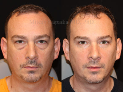 Man in his mid-40s before and six months after upper and lower eyelid surgery, displaying a rejuvenated and less tired appearance