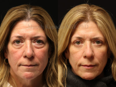 Woman in her mid-50s before and three months after upper and lower eyelid surgery, revealing a more youthful and awake appearance