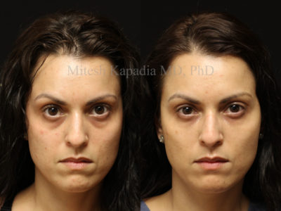 Woman in her mid-30s before and after lower eyelid, midface and cheek filler injections. This patient appears with greatly reduced undereye hollowing and dark circles, giving her a smoother and less tired look