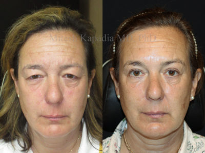 Woman in her mid-50s before and after upper eyelid surgery, revealing a refreshed, more youthful and less tired look