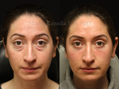 Woman in her mid-30s before and after lower eyelid surgery with undereye filler to help blend the eyelid to cheek junction. This patient appears well rested and rejuvenated after her procedures