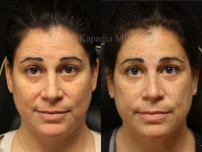 Woman in her mid-40s before and after lower eyelid filler injections, leaving her with diminished dark circles and a well rested look