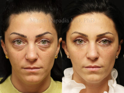 Woman in her mid-30s before and after lower eyelid surgery, also with lower eyelid filler injections to blend the eyelid-cheek junction. This patient displays a vibrant, refreshed appearance without looking overdone or fake
