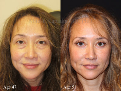 Woman in her 50s before and after lower eyelid surgery, as well as Botox injections, fillers, and radiofrequency microneedling, leaving her with a radiant, youthful appearance