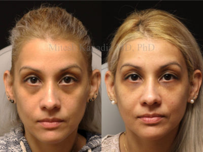 Woman in her early 40s before and after lower eyelid and midface filler injections, revealing the reduced appearance of dark undereye circles, giving her a refreshed and well rested look