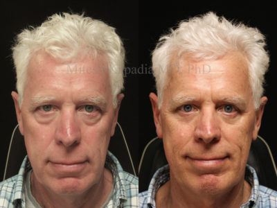 Man in his early 60s before and after upper and lower eyelid surgery, showing a more youthful and rejuvenated appearance without looking overdone or fake