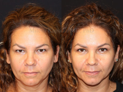 Woman in her mid-40s before and after upper eyelid surgery, displaying a refreshed, natural look after her procedure