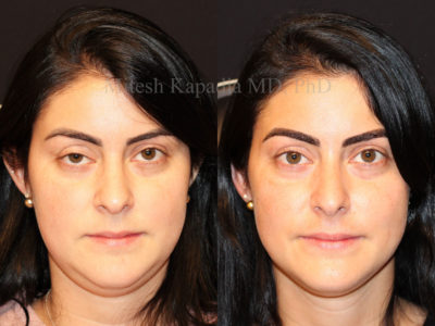 Woman in her late 20s before and after ptosis repair on the right upper eyelid, revealing a more symmetrical appearance