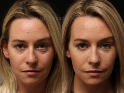 Woman in her early 30s before and after lower eyelid and midface filler injections, leaving her looking refreshed and natural