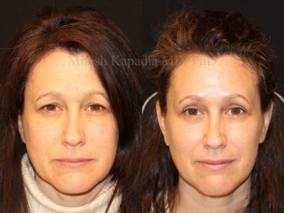 Woman in her early 50s before and after upper eyelid surgery, displaying a refreshed and more youthful appearance