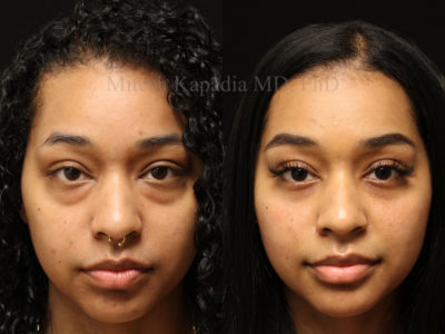 Woman in her 20s before and after lower eyelid surgery, diminishing the appearance of undereye bags, giving her a refreshed and less tired look without seeming overdone or fake