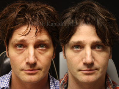Man in his early 40s before and after lower eyelid surgery, giving him a refreshed, more youthful, and less tired appearance while still maintaining a natural look
