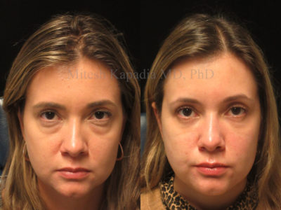Woman in her mid-30s before and after lower eyelid surgery, as well as undereye filler injections during the postoperative period. This patient displays a softer, more youthful and less tired look without looking overdone