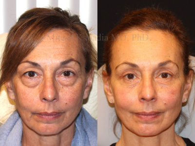 Woman in her late 50s before and after upper and lower eyelid surgery showing a more youthful look while not looking overdone