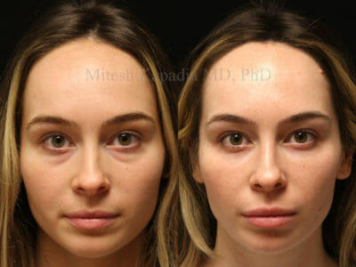 Woman in her late 20s before and after lower blepharoplasty surgery, showing a refreshed and less tired appearance